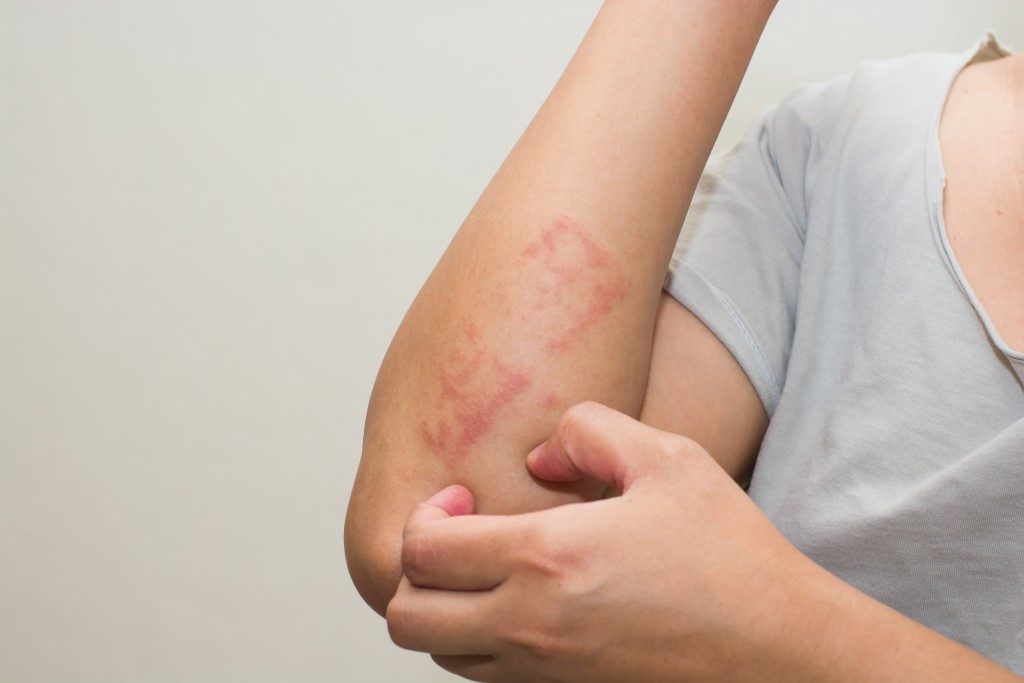 Eczema on a woman's arm
