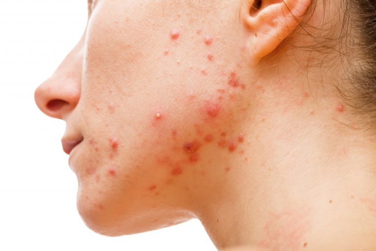 woman with acne on her jaw