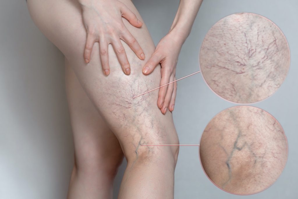 sclerotherapy-spider-vein